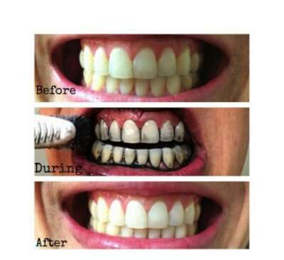 پودر زغال سفید کننده ی دندان miracle
